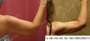Hút mỡ cánh tay, nữ 39 tuổi - ca 40