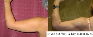 Hút mỡ cánh tay, nữ 37 tuổi - ca 41