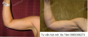 Hút mỡ cánh tay, nữ 37 tuổi - ca 41