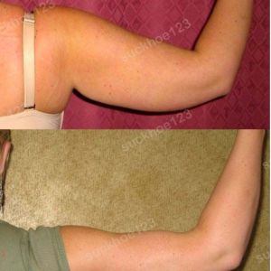 Hút mỡ cánh tay, nữ 25 tuổi - ca 43