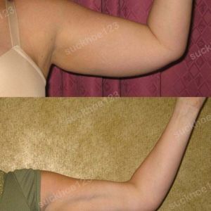 Hút mỡ cánh tay, nữ 25 tuổi - ca 43