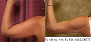 Hút mỡ cánh tay, nữ 42 tuổi - ca 44