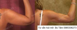 Hút mỡ cánh tay, nữ 42 tuổi - ca 44