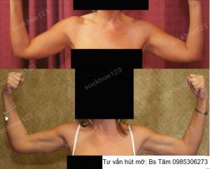 Hút mỡ cánh tay, nữ 42 tuổi - ca 44