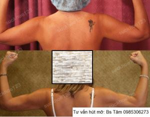 Hút mỡ cánh tay, nữ 42 tuổi - ca 44