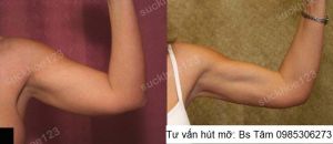 Hút mỡ cánh tay, nữ 42 tuổi - ca 44