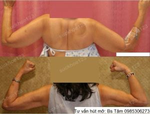 Hút mỡ cánh tay, nữ 52 tuổi - ca 45