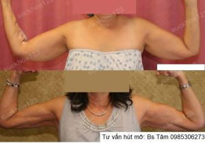 Hút mỡ cánh tay, nữ 52 tuổi - ca 45