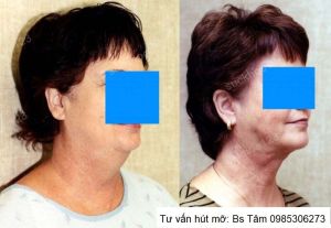 Hút mỡ nọng cằm, nữ 58 tuổi - ca 46