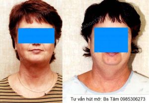 Hút mỡ nọng cằm, nữ 58 tuổi - ca 46