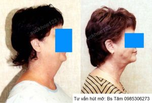 Hút mỡ nọng cằm, nữ 58 tuổi - ca 46