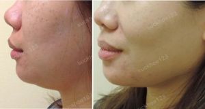 Hút mỡ nọng cằm, nữ 32 tuổi - ca 47