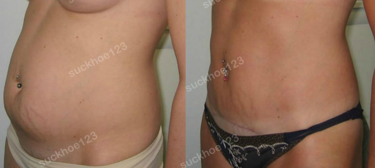 01 mini tummy tuck