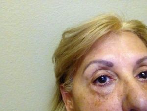 Ngoài matxa để giảm sưng bầm ở mí dưới, có thể làm gì khác?