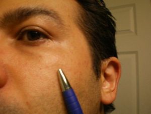 Có thể xử lý khối phồng này ở ngay tại phòng khám không? Liệu có rủi ro gì không?