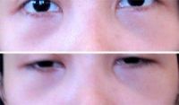 Cơ mí dưới căng chặt sau phẫu thuật: hiện tượng này có bình thường không?