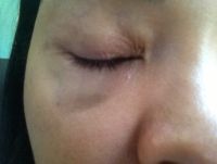 5 tuần sau cắt mí dưới da vẫn bị bầm, có màu nâu sẫm dưới mắt?