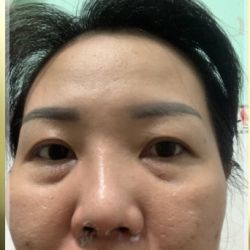 Mũi 1 tháng sau nâng