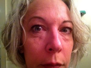 Cắt mí dưới sau khi tiêm Restylane và tiêm tan Hyaluronidase có được không?