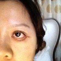 Mí dưới của tôi bị xệ nặng sau phẫu thuật, phải matxa như nào để khắc phục?
