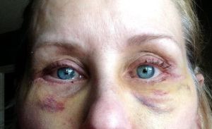 Dịch nhầy ở mắt sau 8 ngày cắt mí dưới như này có bình thường không?