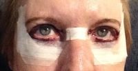 Tại sao bác sĩ lại dán rất nhiều băng steri strips ở mí dưới của tôi như này?