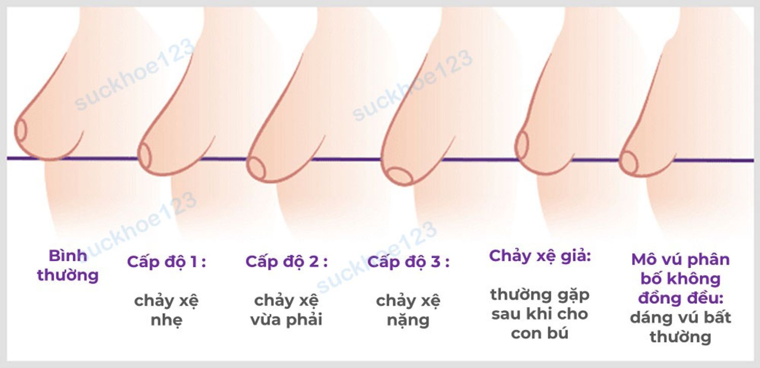 các cấp độ ngực chảy xệ