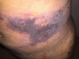 Phát hiện những vệt đen trên bụng ngay hôm đầu sau hút mỡ – có phải là hoại tử không?