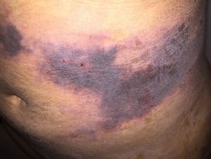 Phát hiện những vệt đen trên bụng ngay hôm đầu sau hút mỡ – có phải là hoại tử không?