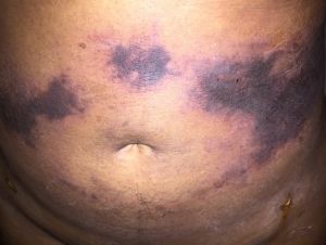 Phát hiện những vệt đen trên bụng ngay hôm đầu sau hút mỡ – có phải là hoại tử không?