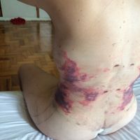 Tôi vẫn bị bầm tím sau hút mỡ hai tháng – liệu máu bầm có tan được không? Tôi vẫn bị bầm tím sau hút mỡ hai tháng – liệu máu bầm có tan được không?