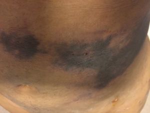 Phát hiện những vệt đen trên bụng ngay hôm đầu sau hút mỡ – có phải là hoại tử không?