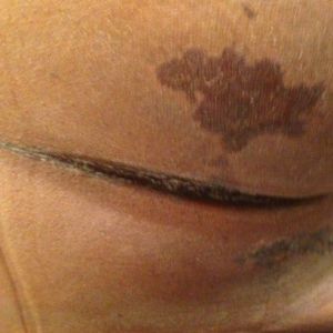 Có phải tôi đã bị hoại tử sau hút mỡ?