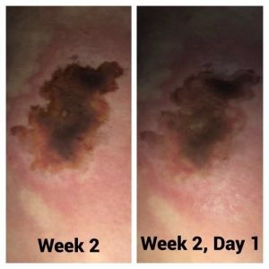 Tôi đã hút mỡ 18 ngày trước và không bị bỏng, nhưng có vùng da bị đỏ và đổi màu, vậy tôi bị hoại tử, viêm mô bào hay là bị nhiễm trùng?