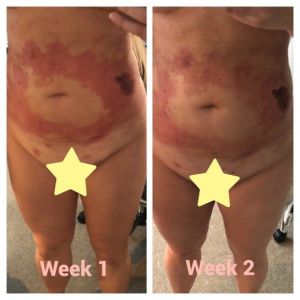 Tôi đã hút mỡ 18 ngày trước và không bị bỏng, nhưng có vùng da bị đỏ và đổi màu, vậy tôi bị hoại tử, viêm mô bào hay là bị nhiễm trùng?