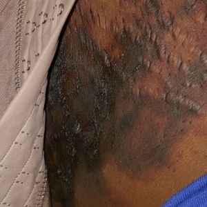 Tôi hút mỡ từ 7 ngày trước, bây giờ đang lo không biết những mảng đen này là hoại tử hay bầm tím?