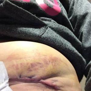 Có phải tôi đã bị hoại tử sau hút mỡ ụ hông không?