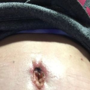 Có phải tôi đã bị hoại tử sau hút mỡ ụ hông không?