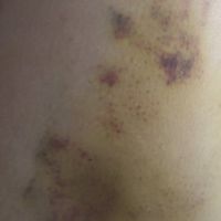Hút mỡ từ 2 tháng trước, có phải tôi đã bị hoại tử mỡ? Hút mỡ từ 2 tháng trước, có phải tôi đã bị hoại tử mỡ?