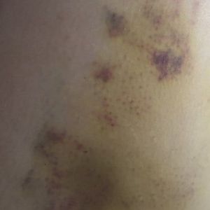 Hút mỡ từ 2 tháng trước, có phải tôi đã bị hoại tử mỡ?