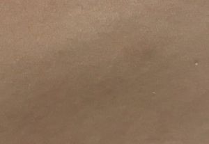 Hút mỡ từ 2 tháng trước, có phải tôi đã bị hoại tử mỡ?