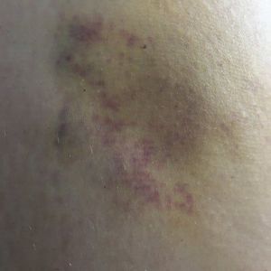 Hút mỡ từ 2 tháng trước, có phải tôi đã bị hoại tử mỡ?