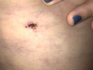 Có phải tôi đã bị nhiễm trùng-hoại tử vết mổ sau hút mỡ? Tôi đã làm phẫu thuật được 5 ngày – mai là tái khám nhưng tôi vẫn rất lo lắng