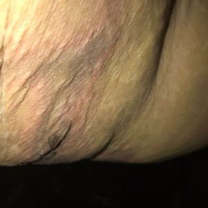 Tôi đã hút mỡ hai cánh tay từ 8 ngày trước, tôi nghi mình bị hoại tử dù bác sĩ khẳng định chỉ là máu tụ dưới da