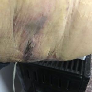 Tôi đã hút mỡ hai cánh tay từ 8 ngày trước, tôi nghi mình bị hoại tử dù bác sĩ khẳng định chỉ là máu tụ dưới da