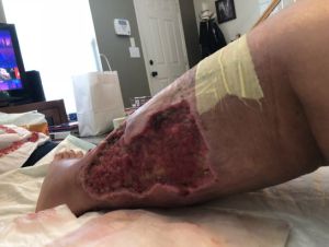 Tôi có bắt buộc phải dùng hệ thống băng hút áp lực âm trước khi cấy ghép da không, hay có thể bỏ qua phần hút chân không? Có bắt buộc phải dùng máy hút áp lực âm trước trong mọi trường hợp không?