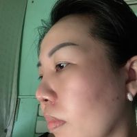 Mũi 1 tháng sau nâng Mũi 1 tháng sau nâng