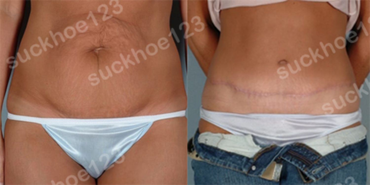 full tummy tuck2