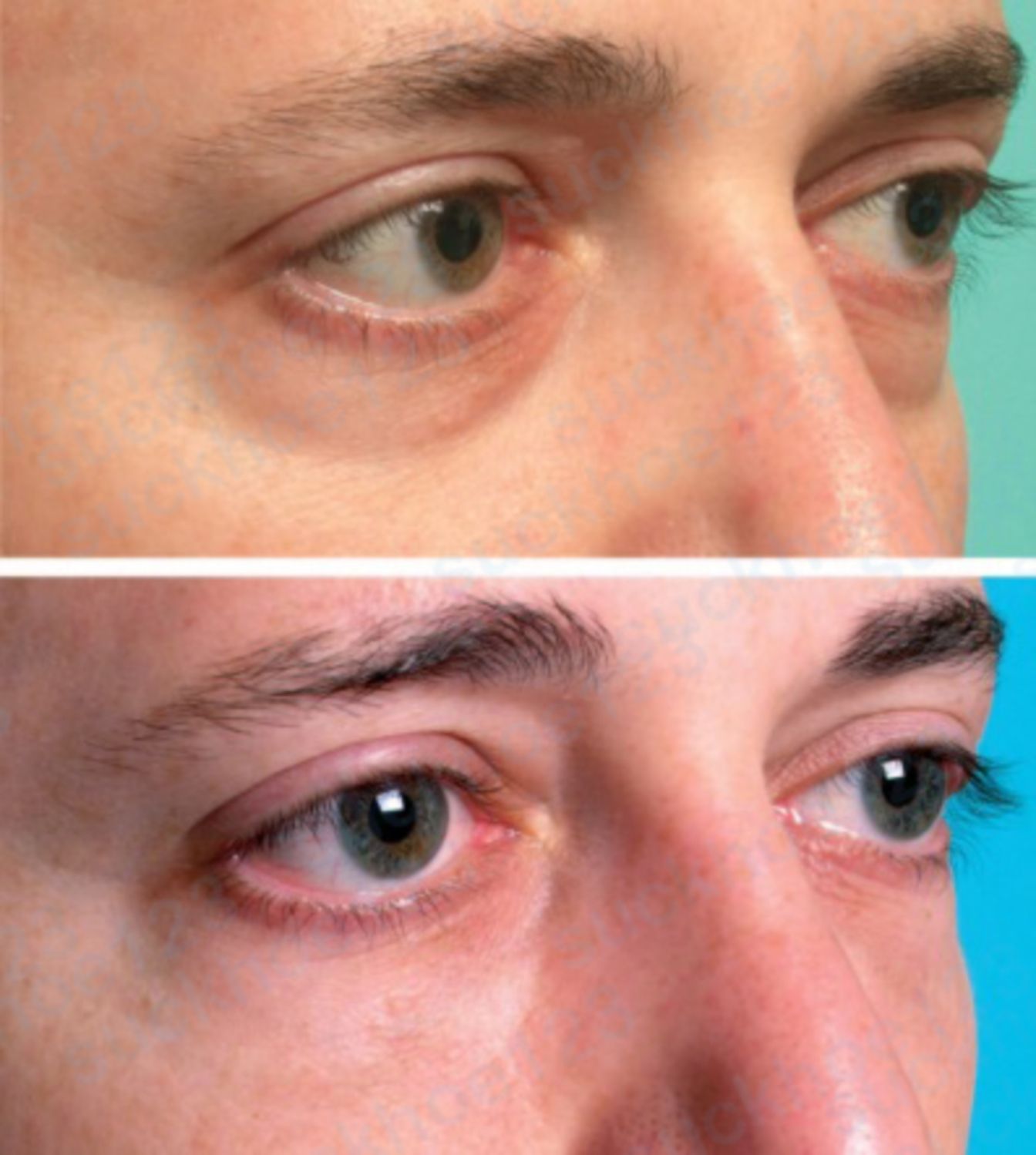 hình 10 trị rãnh nước mắt bằng tiêm filler