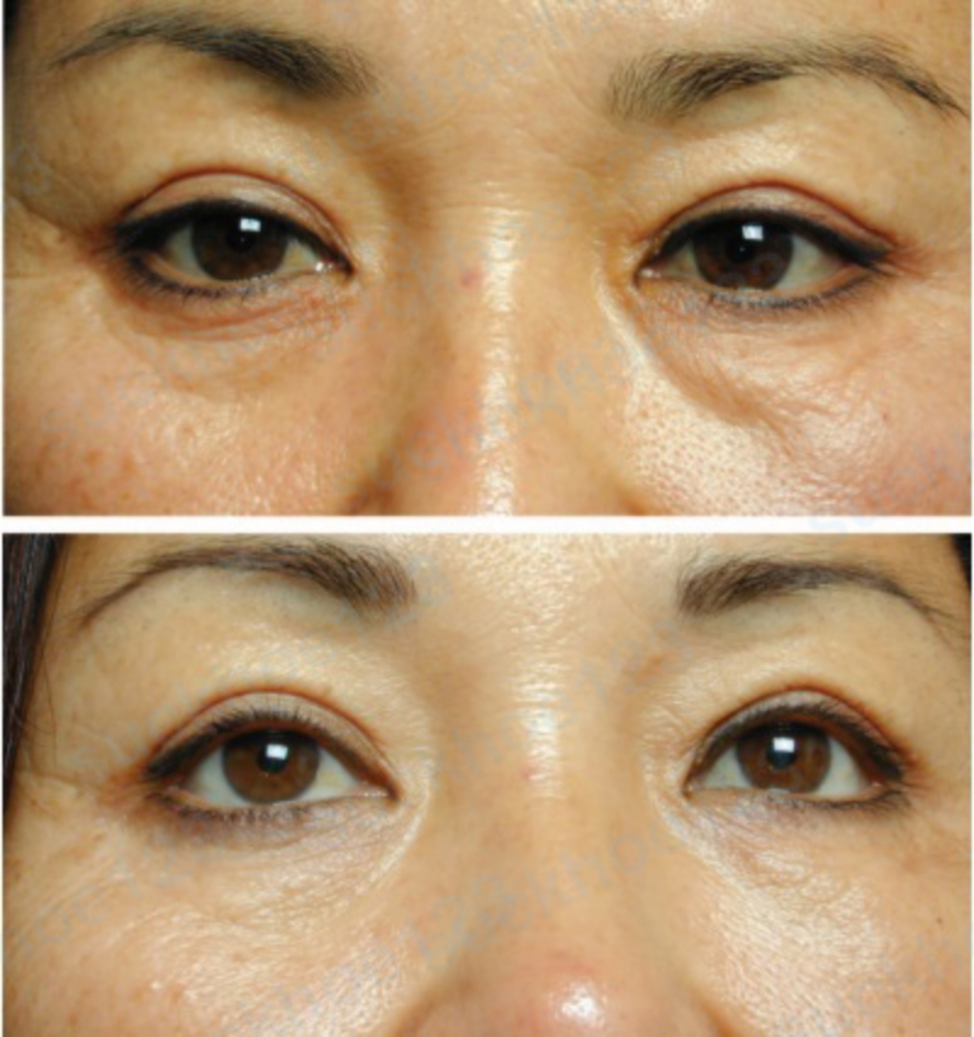 hình 8 trị dịch mí mắt A 48 year old woman with grade 3 fluid bags before